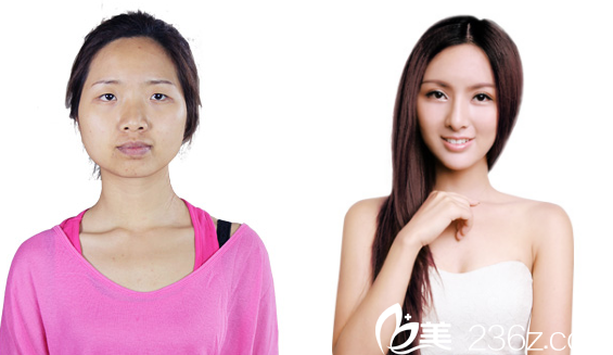 深圳美萊梁曉健隆鼻前后對比圖