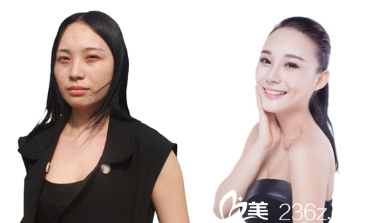 深圳美萊梁曉健主任隆鼻案例