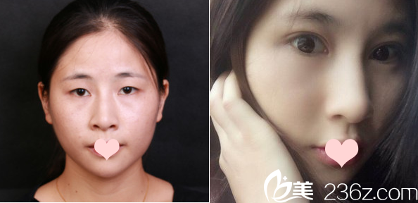 深圳美萊梁志為雙眼皮案例之開內(nèi)眼角 深圳美萊梁志為雙眼皮案例之開內(nèi)眼角