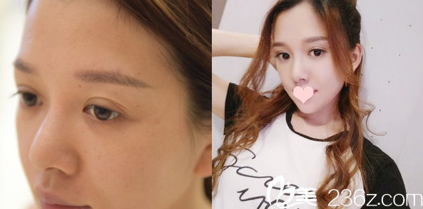 深圳美萊梁志為切開雙眼皮案例 深圳美萊梁志為切開雙眼皮案例