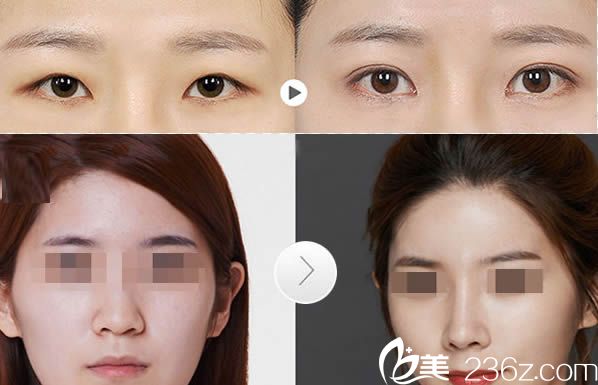 張潮院長雙眼皮和假體隆鼻案例