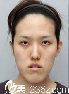 顴骨整形術(shù)前