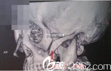 顴骨顴弓手術(shù)骨塊下移