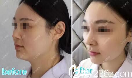 術(shù)后即刻的前后對比 術(shù)后即刻的前后對比