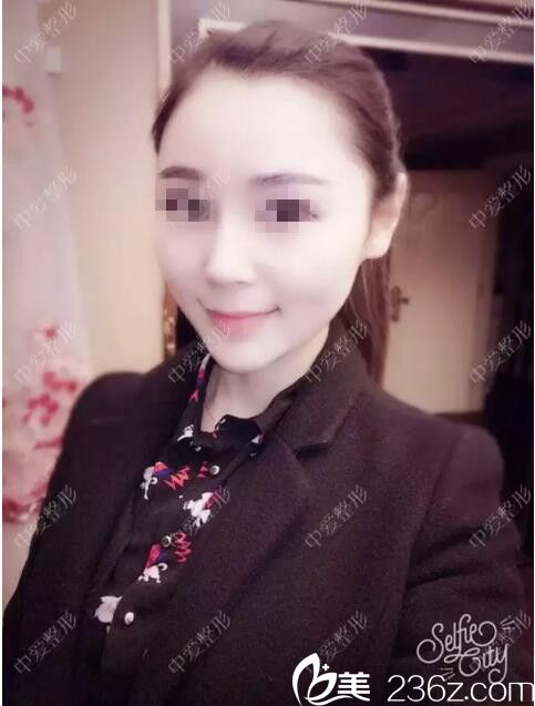 湖北黃石中愛內(nèi)部員工玻尿酸隆鼻+豐下巴整形經(jīng)歷