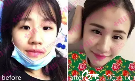 長(zhǎng)沙雅美割雙皮案例