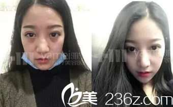 長(zhǎng)沙雅美隆鼻真人案例