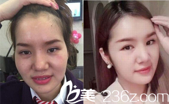 長(zhǎng)沙雅美自體脂肪填充真人案例