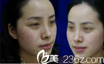 長(zhǎng)沙雅美激光祛斑案例