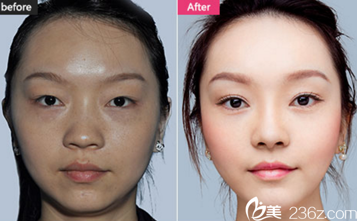 長(zhǎng)沙美萊隆鼻+雙眼皮+瘦臉真人案例