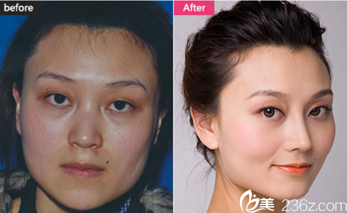 長(zhǎng)沙美萊塑鼻+自體脂肪填充真人案例