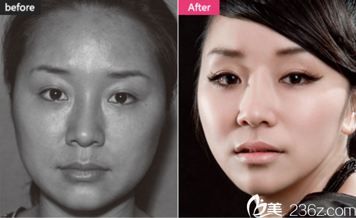 長(zhǎng)沙美萊整形雙眼皮真人案例