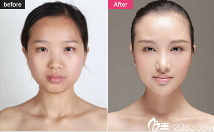 長(zhǎng)沙美萊雙眼皮+隆鼻+自體脂肪填充真人案例