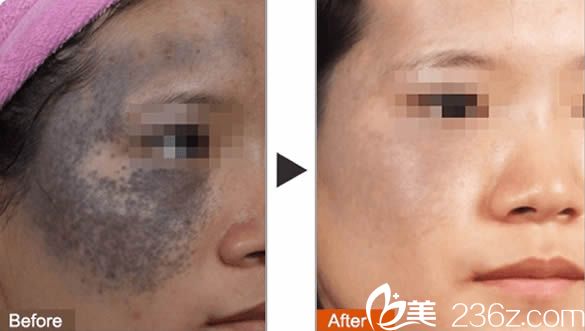 蔣曉玲主任治療大田痣效果圖