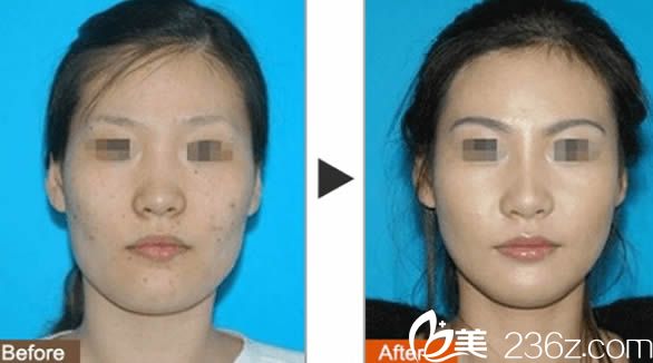 蔣曉玲激光祛斑前后對比圖