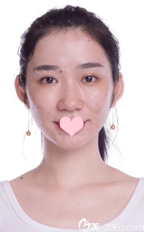 自體脂肪填充術前照片 自體脂肪填充術前照片