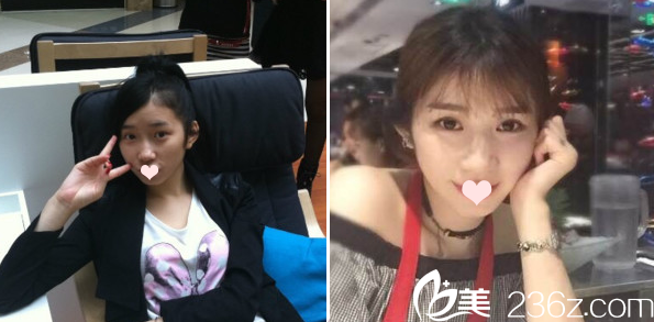 術前照片 術前照片