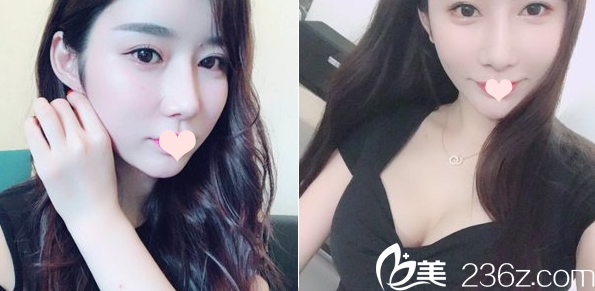 廣州紫馨鼻綜合+隆胸案例 廣州紫馨鼻綜合+隆胸案例