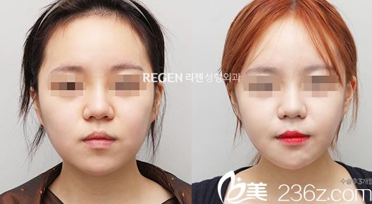 吳銘埈的面部輪廓案例 吳銘埈的面部輪廓案例