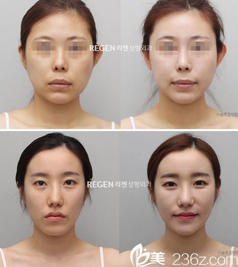 權錫玟院長的抗衰老案例圖 權錫玟院長的抗衰老案例圖