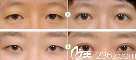 羅德豐院長雙眼皮案例