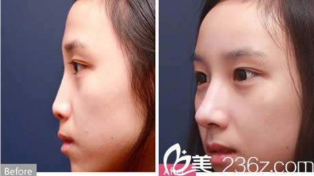 羅德豐假體隆鼻案例效果圖