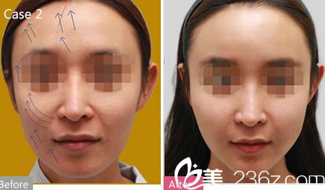 羅德豐醫(yī)生面部精雕前后對比圖