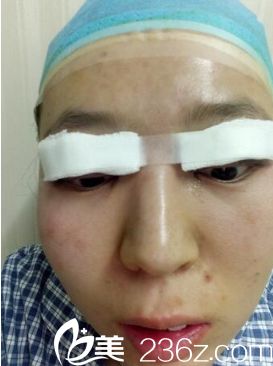 西安同安濟(jì)醫(yī)院雙眼皮整形真人案例 西安同安濟(jì)醫(yī)院雙眼皮整形真人案例