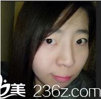 西安同安濟醫(yī)院美容科做雙眼皮怎么樣？真人案例告訴你