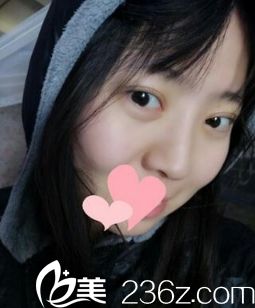 西安同安濟(jì)醫(yī)院雙眼皮手術(shù)恢復(fù)后第30天 西安同安濟(jì)醫(yī)院雙眼皮手術(shù)恢復(fù)后第30天