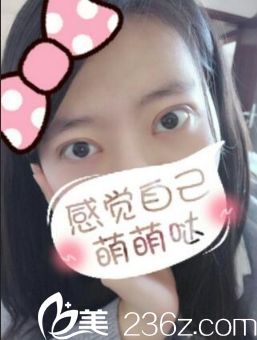 西安同安濟(jì)醫(yī)院雙眼皮手術(shù)恢復(fù)后第20天 西安同安濟(jì)醫(yī)院雙眼皮手術(shù)恢復(fù)后第20天