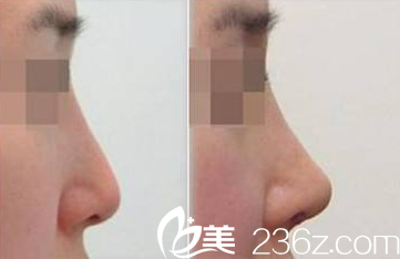單磊醫(yī)生鼻部整形案例