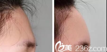 自體脂肪豐額頭