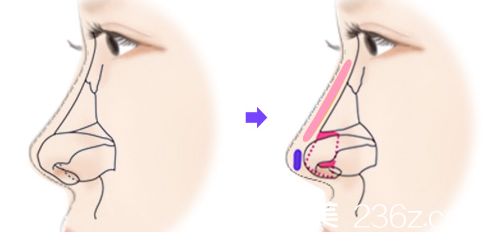 鼻綜合從整體上改變鼻子形態(tài)