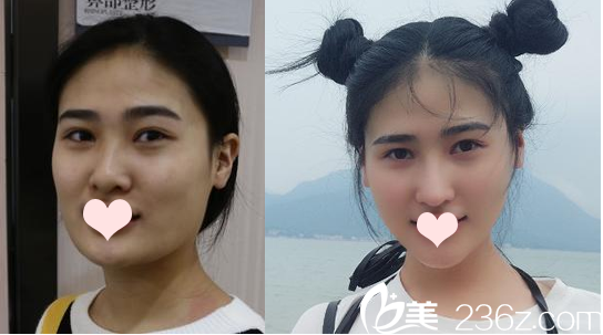 羅志敏肋軟骨隆鼻案例 羅志敏肋軟骨隆鼻案例