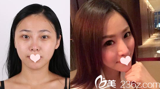 羅志敏鼻綜合隆鼻案例 羅志敏鼻綜合隆鼻案例