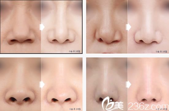 崔珉碩院長(zhǎng)的隆鼻案例 崔珉碩院長(zhǎng)的隆鼻案例