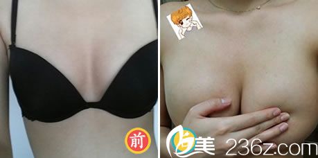 金起甲院長做假體隆胸案例 金起甲院長做假體隆胸案例