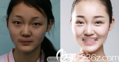 劉曉榮6D明星眼術(shù)前術(shù)后對(duì)比 劉曉榮6D明星眼術(shù)前術(shù)后對(duì)比