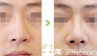 周順波隆鼻術(shù)后正面效果對(duì)比照片