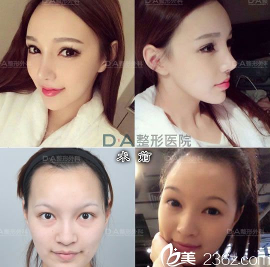 孫豪成院長的鼻部整形案例 孫豪成院長的鼻部整形案例