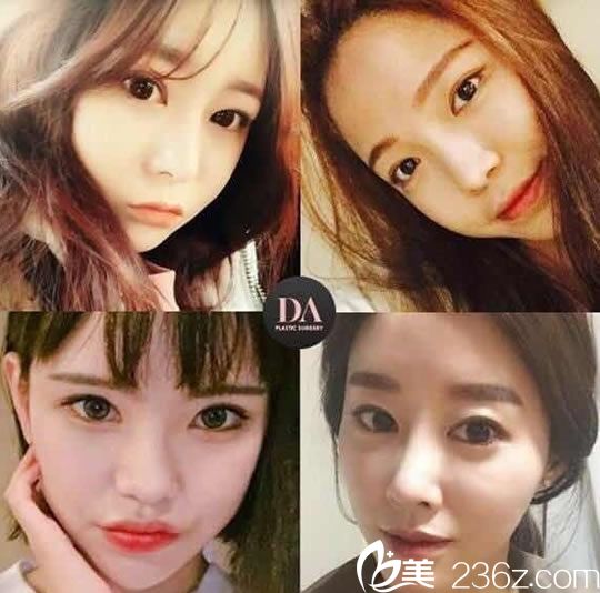 孫豪成院長做眼整形案例圖 孫豪成院長做眼整形案例圖