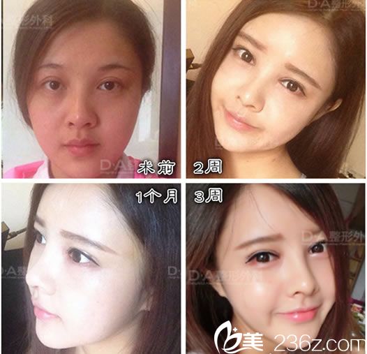 李炅默院長的眼鼻整形案例