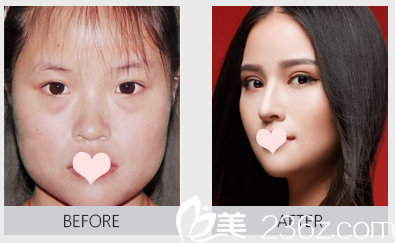 整形醫(yī)院李鵬祛眼袋案例 整形醫(yī)院李鵬祛眼袋案例