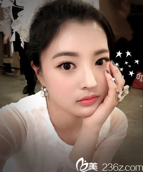 雙眼皮開眼角手術(shù)8個月效果 雙眼皮開眼角手術(shù)8個月效果