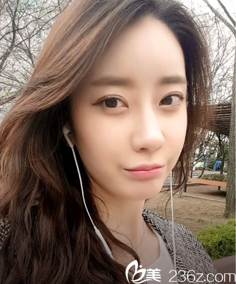 埋線雙眼皮手術(shù)后5個月效果 埋線雙眼皮手術(shù)后5個月效果