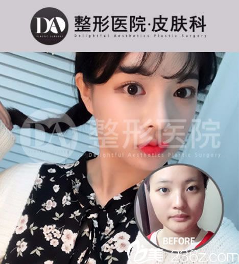 DA整形外科雙眼皮手術(shù)案例 DA整形外科雙眼皮手術(shù)案例