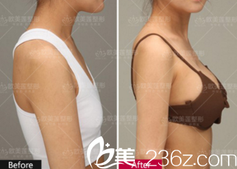 太原歐美蓮姚冰院長隆胸案例