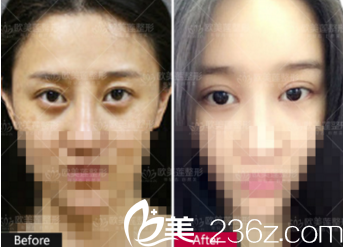 太原歐美蓮姚冰院長雙眼皮失敗修復