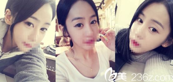 青島壹美整形醫(yī)院雙眼皮手術(shù)案例